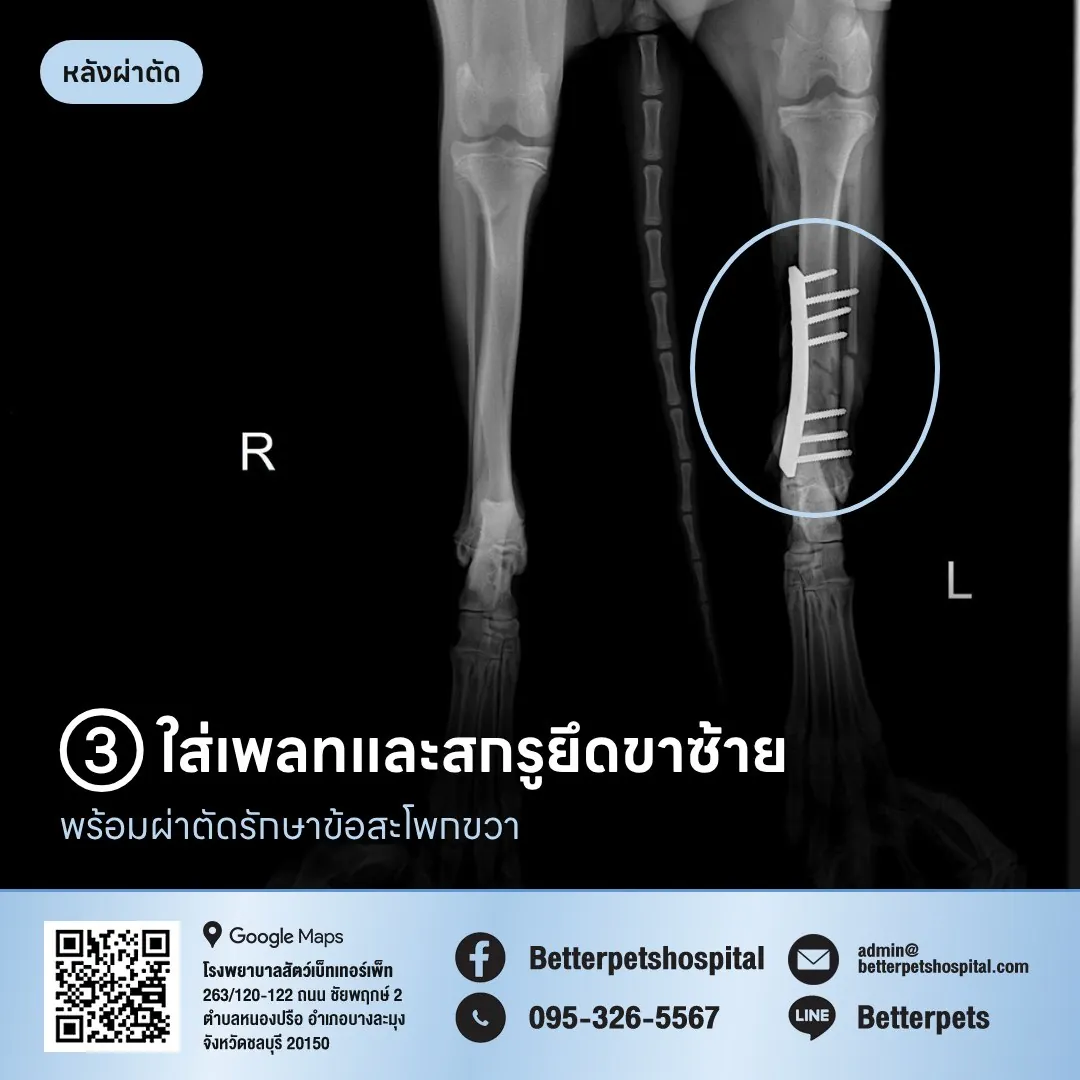 เอ็กซเรย์หลังผ่าตัดใส่เพลทและสกรูขาหลังซ้าย